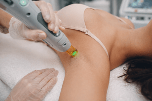 Everything You Need to Know About Laser Hair Removal in Burwood